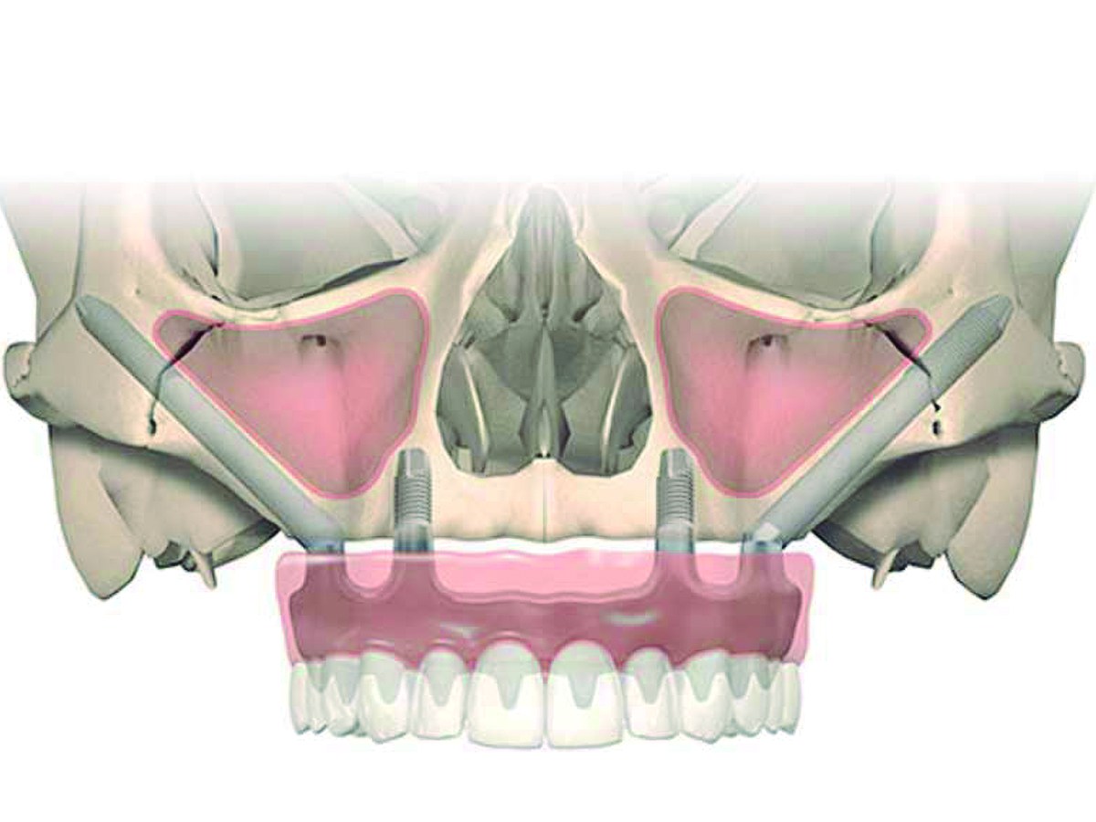 Implantes Zigomáticos: a solução para eliminar o enxerto ósseo